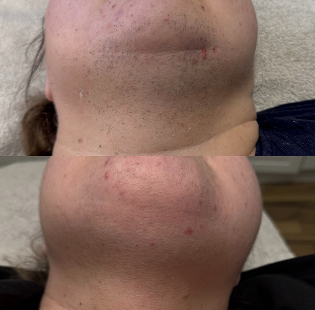 Före och efter laser hårborttagning – haka & hals