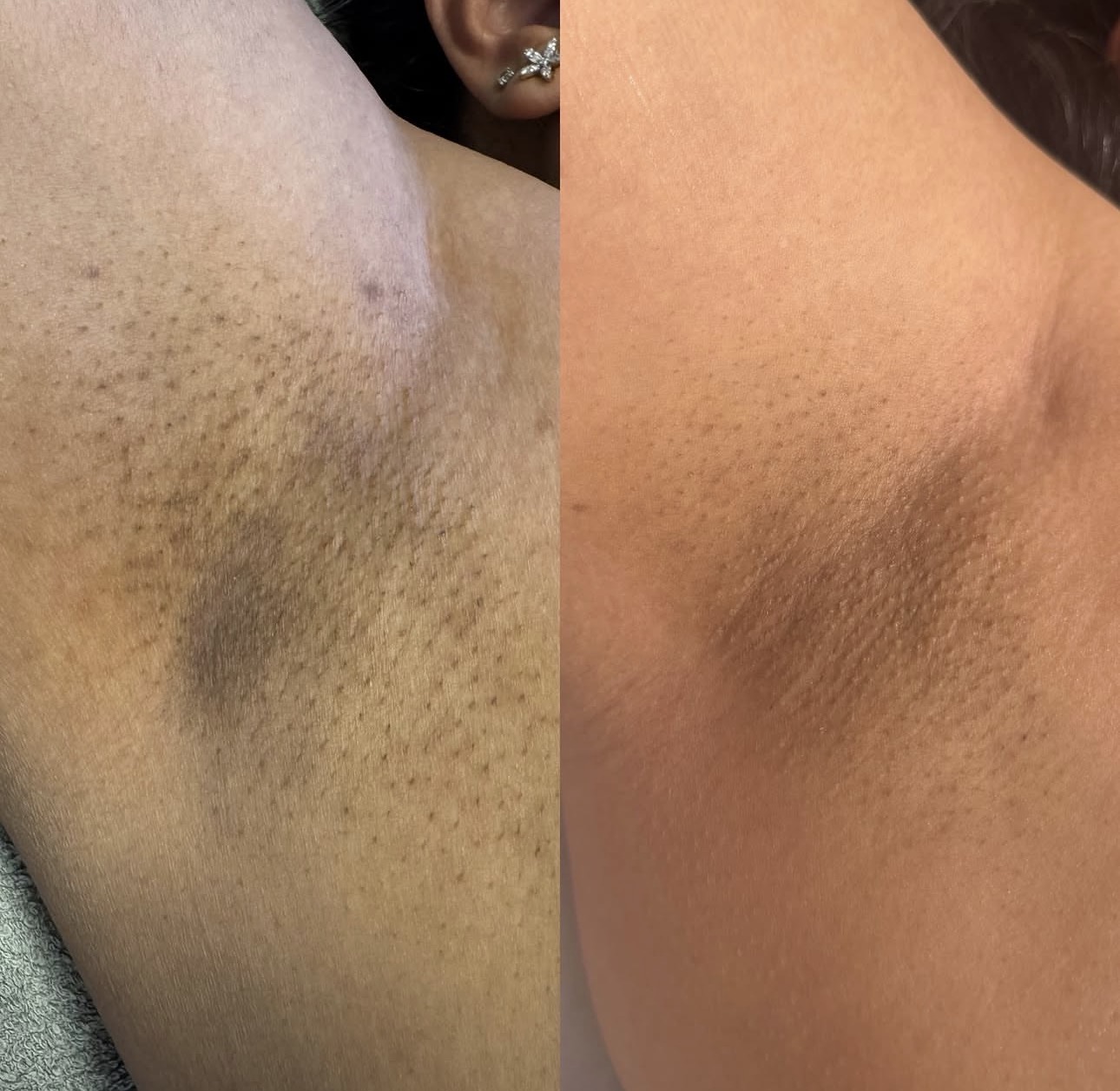 Före och efter laser hårborttagning — Armhåla