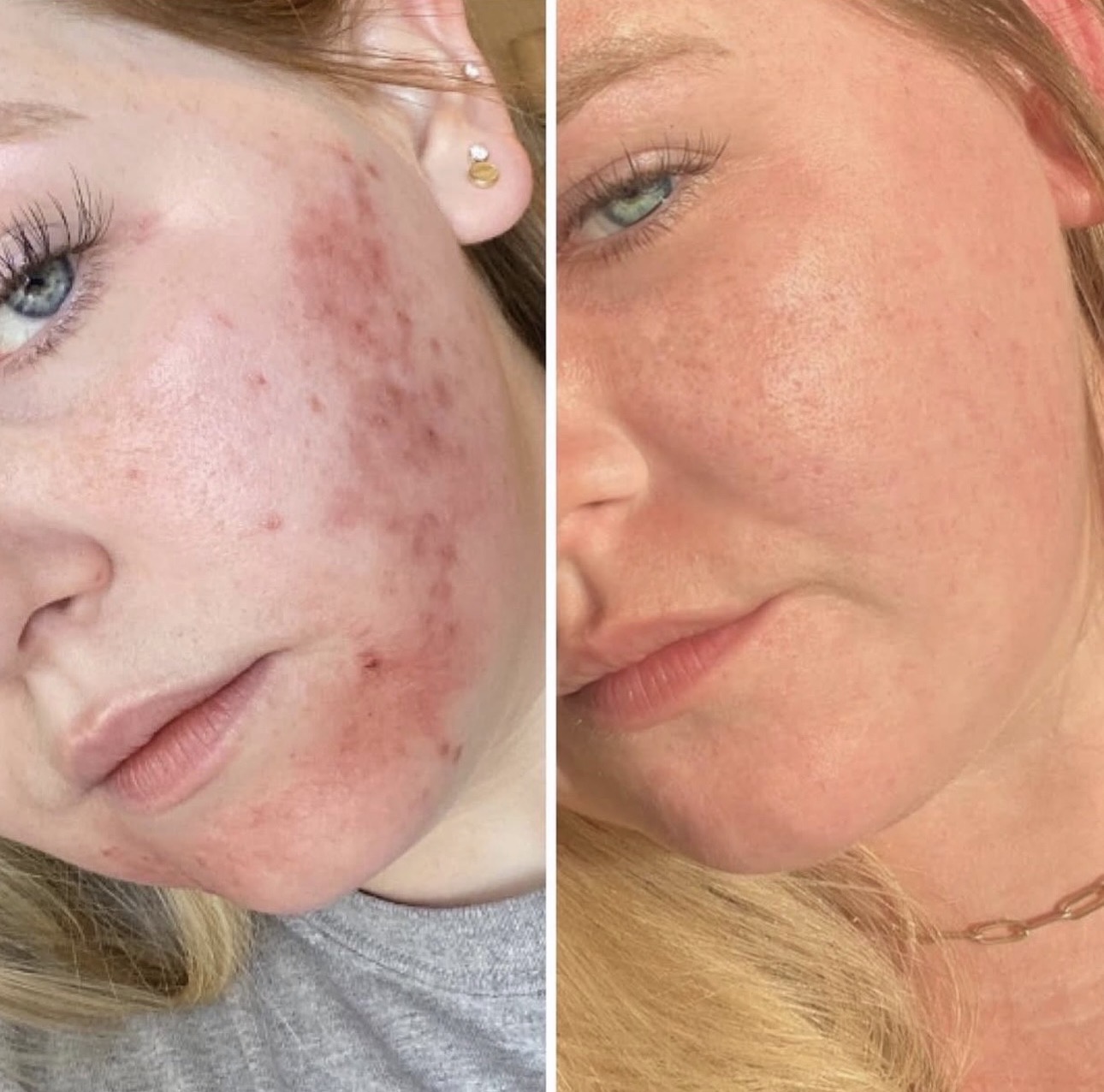 Före och efter microneedling – aknеärr