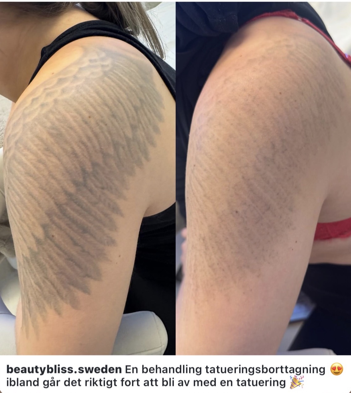 Före och efter tatueringsborttagning — Tatuering på axel – efter en behandling
