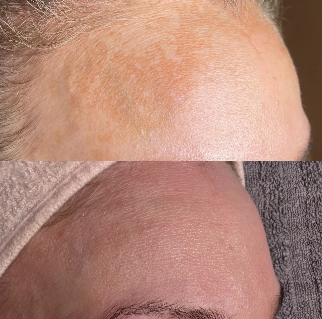 Före och efter microneedling — Pigmentfläckar – panna
