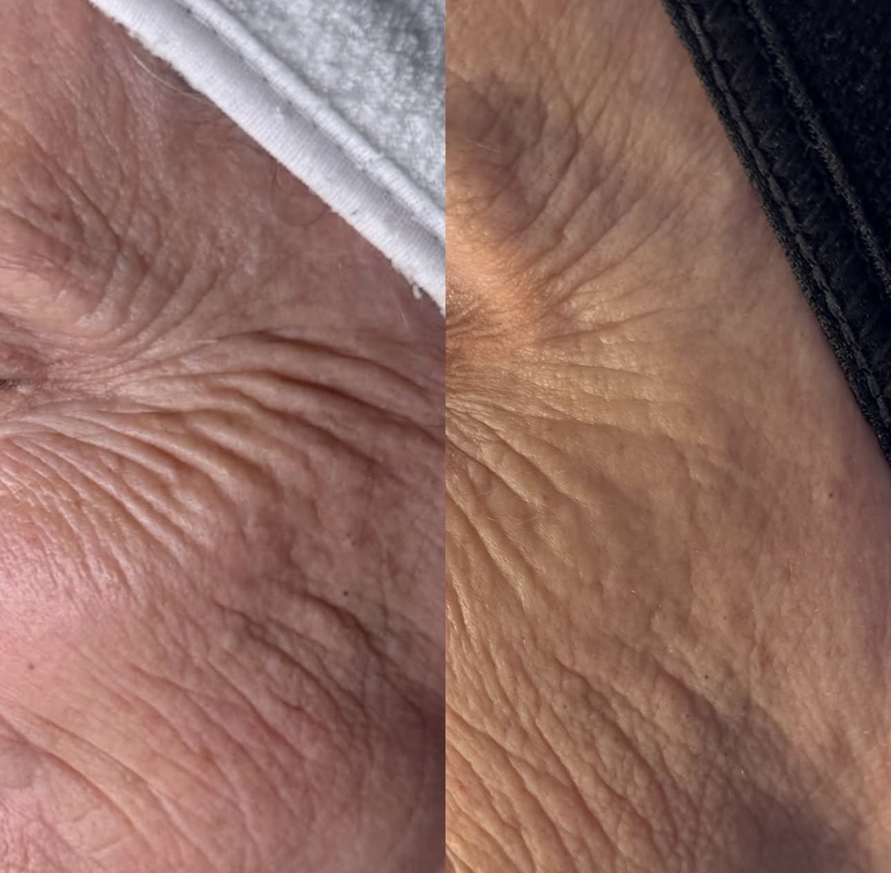 Före och efter microneedling — Fina linjer & rynkor