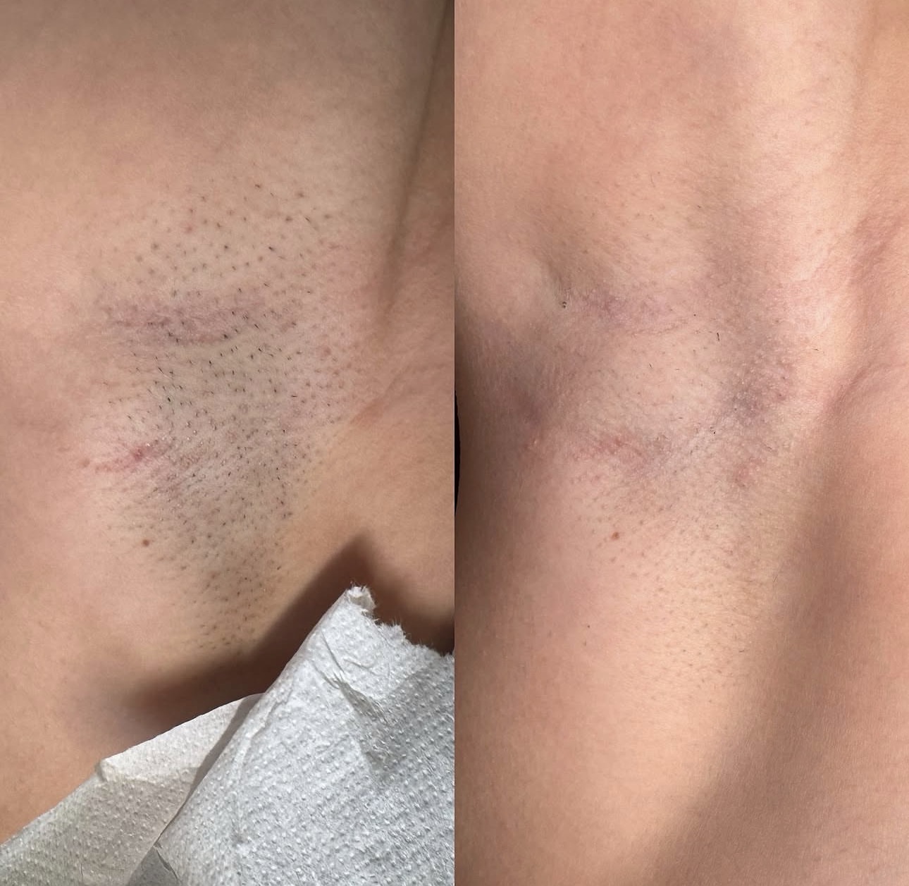 Före och efter laser hårborttagning – bikinilinje