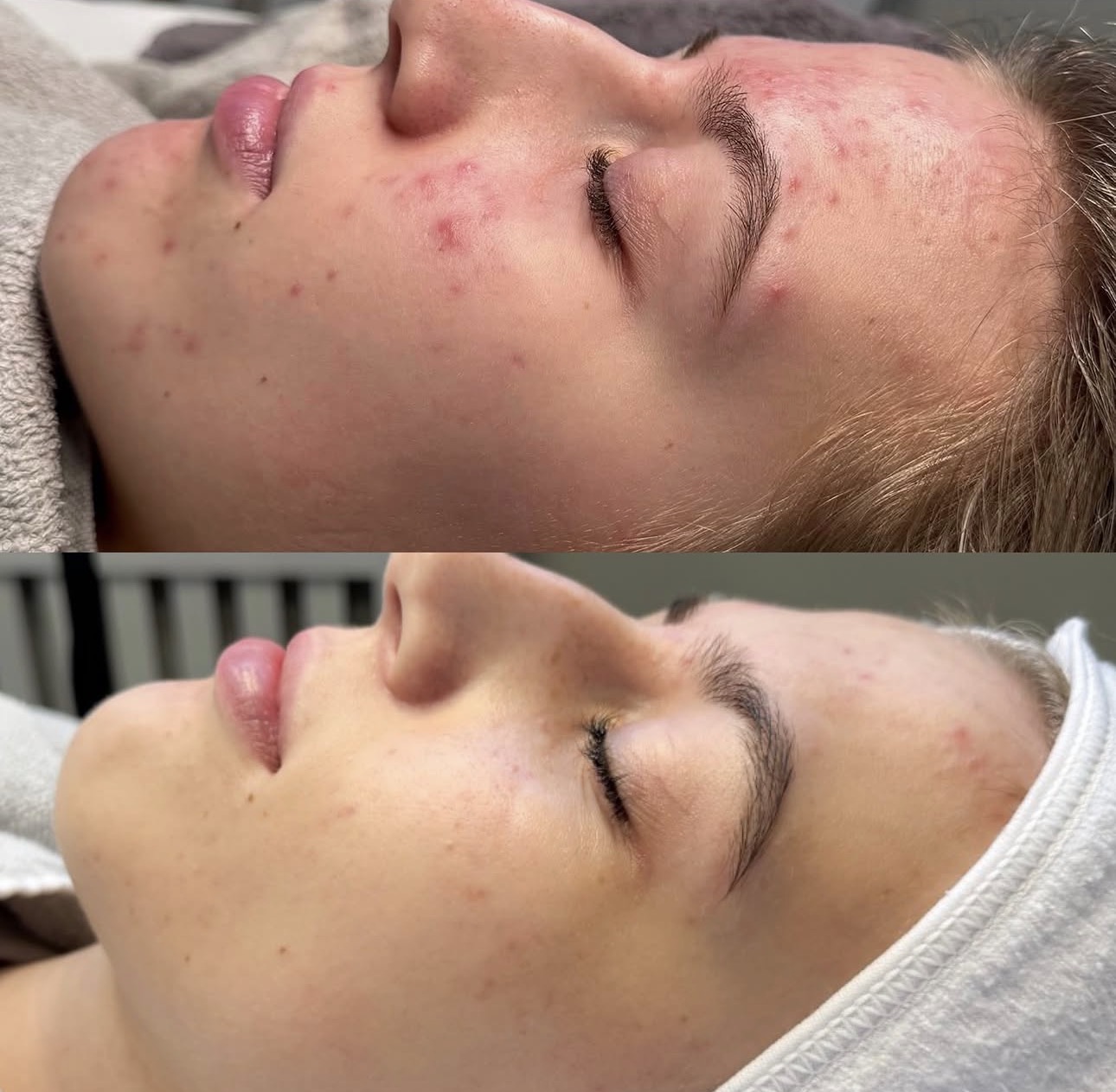 Före och efter microneedling — Aktiv akne – kind & panna