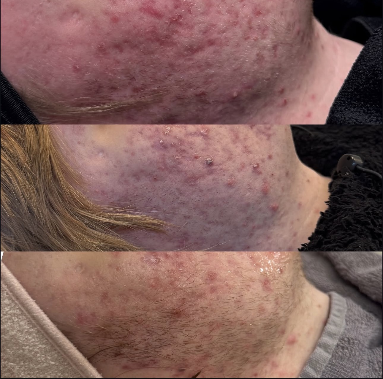 Före och efter microneedling — Akne – hals & käklinje