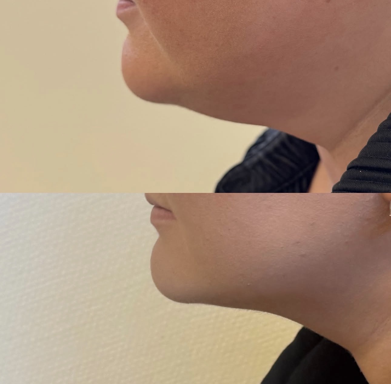 Före och efter fettfrysning — Haka & käklinje