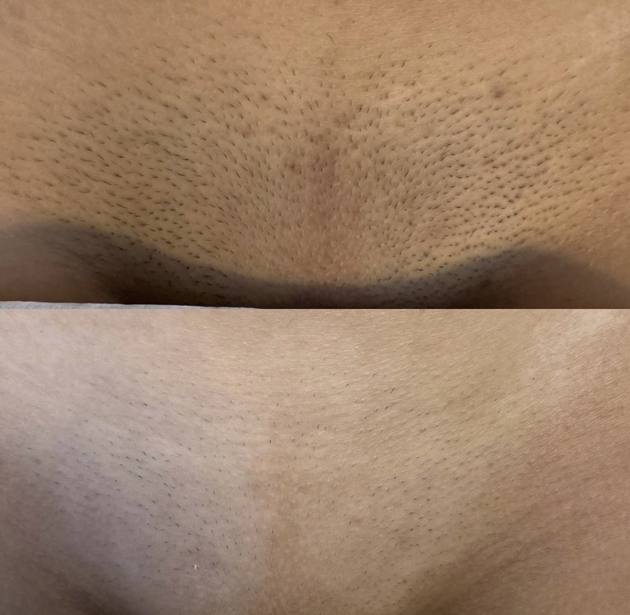 Före och efter laser hårborttagning — Ljumske